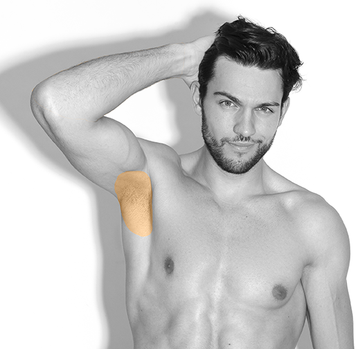 Epilare cu laser axile