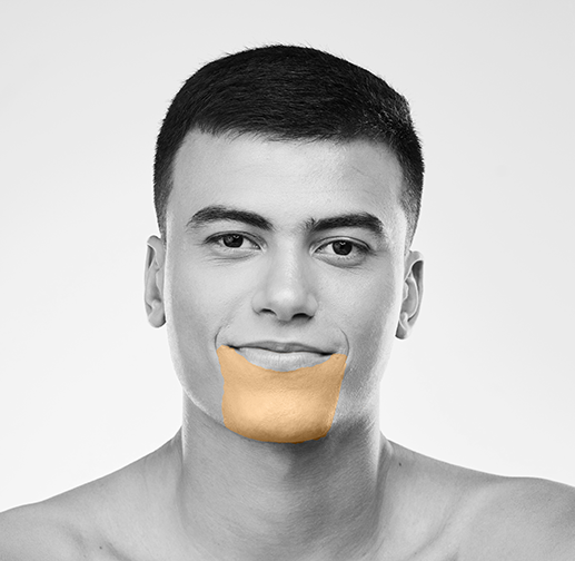 Epilare cu laser bărbie