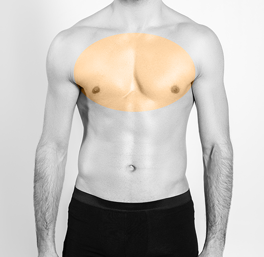 Epilare cu laser piept