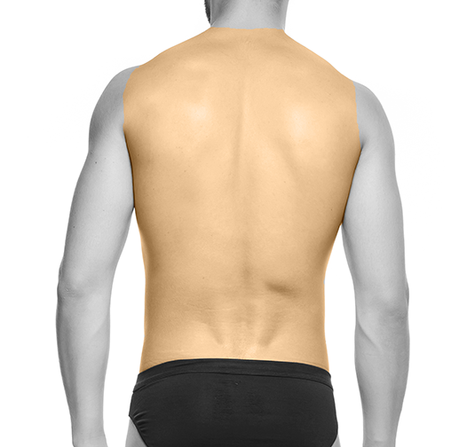 Epilare cu laser spate