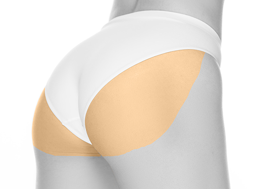Epilare cu laser fese