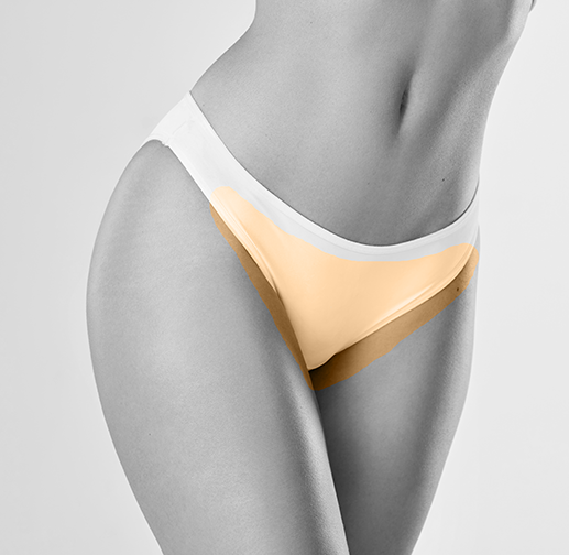 Epilare cu laser inghinal complet
