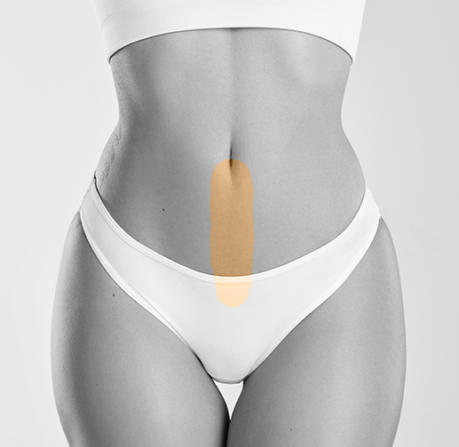 Epilare cu laser linia alba