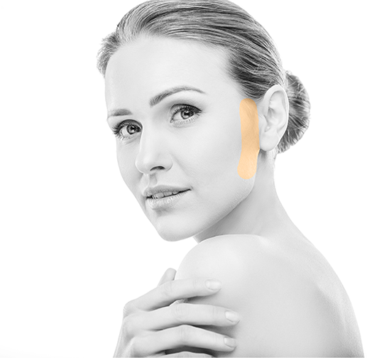 Epilare cu laser perciuni